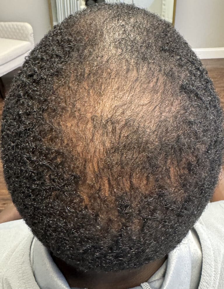 Before Image: PRP Hair Restoration - back
